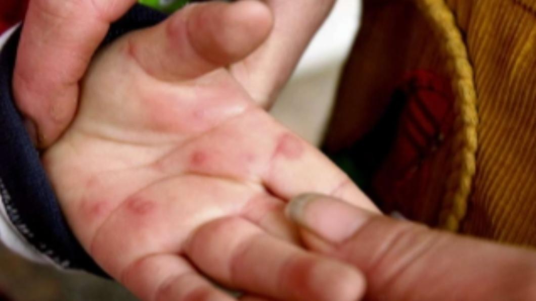 患者主要症狀為全身爆發紅色、疼痛的水泡，且會逐漸變得和番茄一樣大。（圖／翻攝自每日郵報）