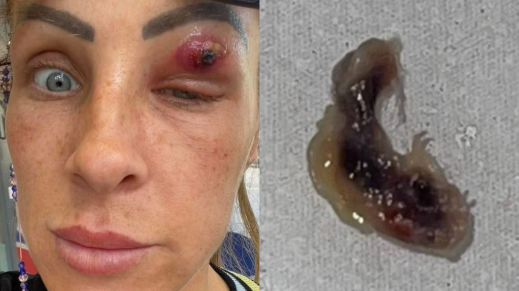 悚!女眼皮腫脹睜不開眼 熱水淋燙傷口竄「異形寄生蟲」