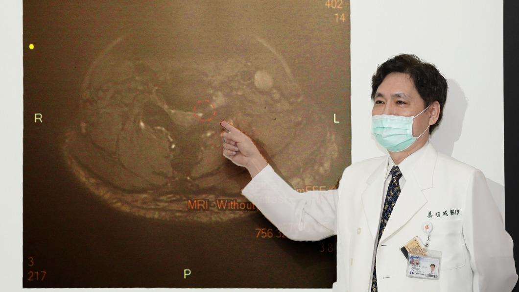 新光醫院神經外科主任蔡明成。（圖／院方提供）