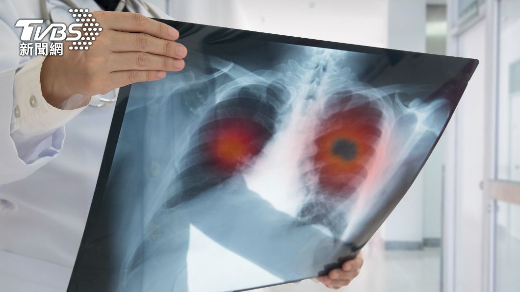 罹患癌症要經歷各種治療與可能的副作用。(示意圖/shutterstock達志影像)