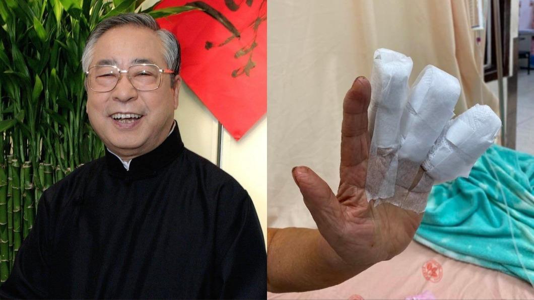 86歲李富城才爆失智!驚傳「3手指被壓扁」急送醫動刀