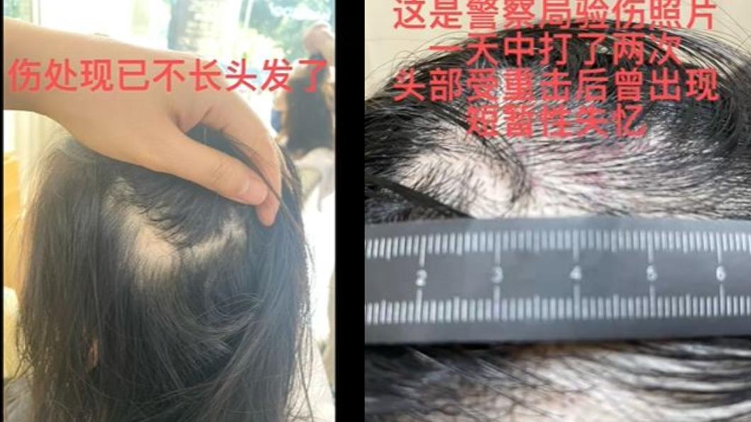 Annepple還PO出多張瘀青照。（圖／翻攝自微博）