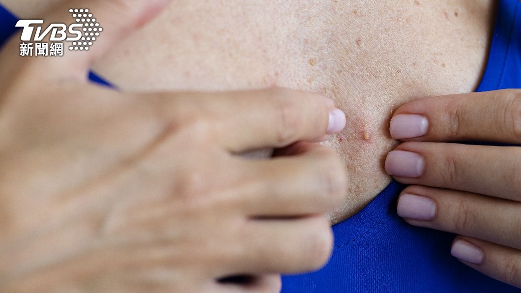 熟女胸前「青春痘」突變青紫色...醫一看慘了:罹1癌