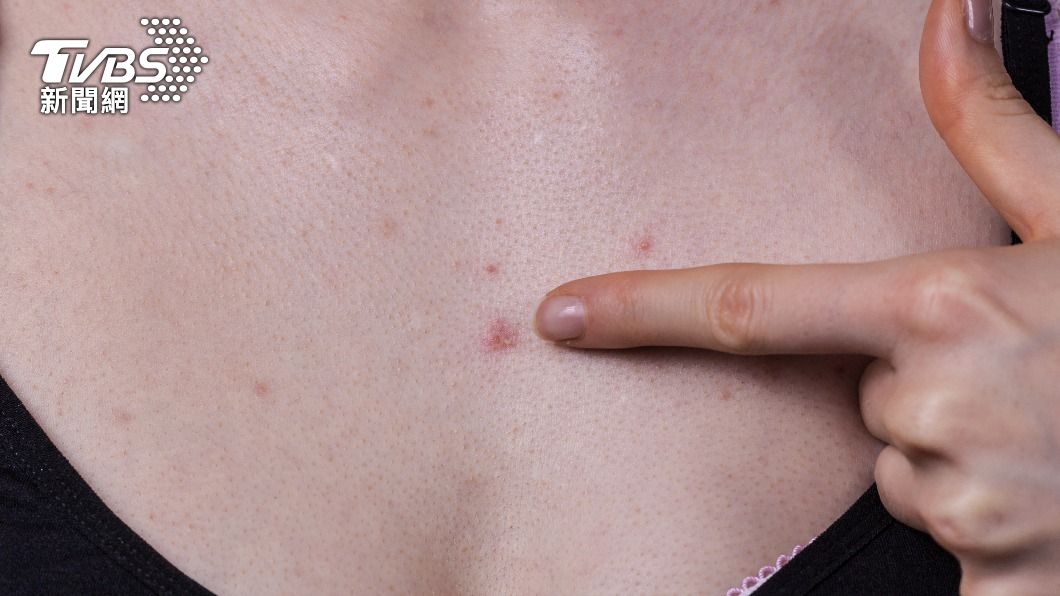 女子經檢查後,發現罹患乳線癌。(示意圖/shutterstock達志影像)