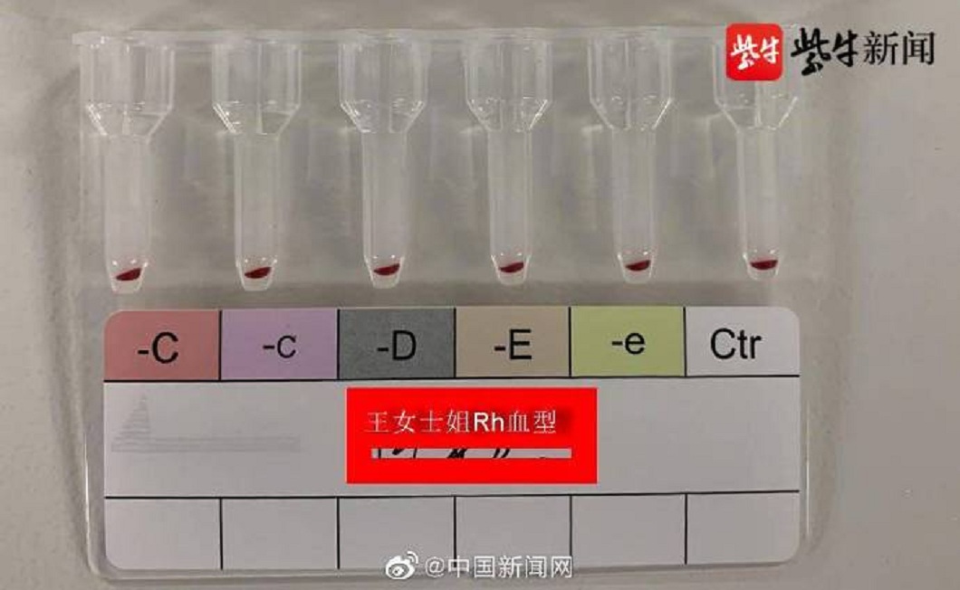 院方檢查發現女子擁有超罕見血型被稱為黃金血液全球不到50人。(圖/翻攝自中新網)