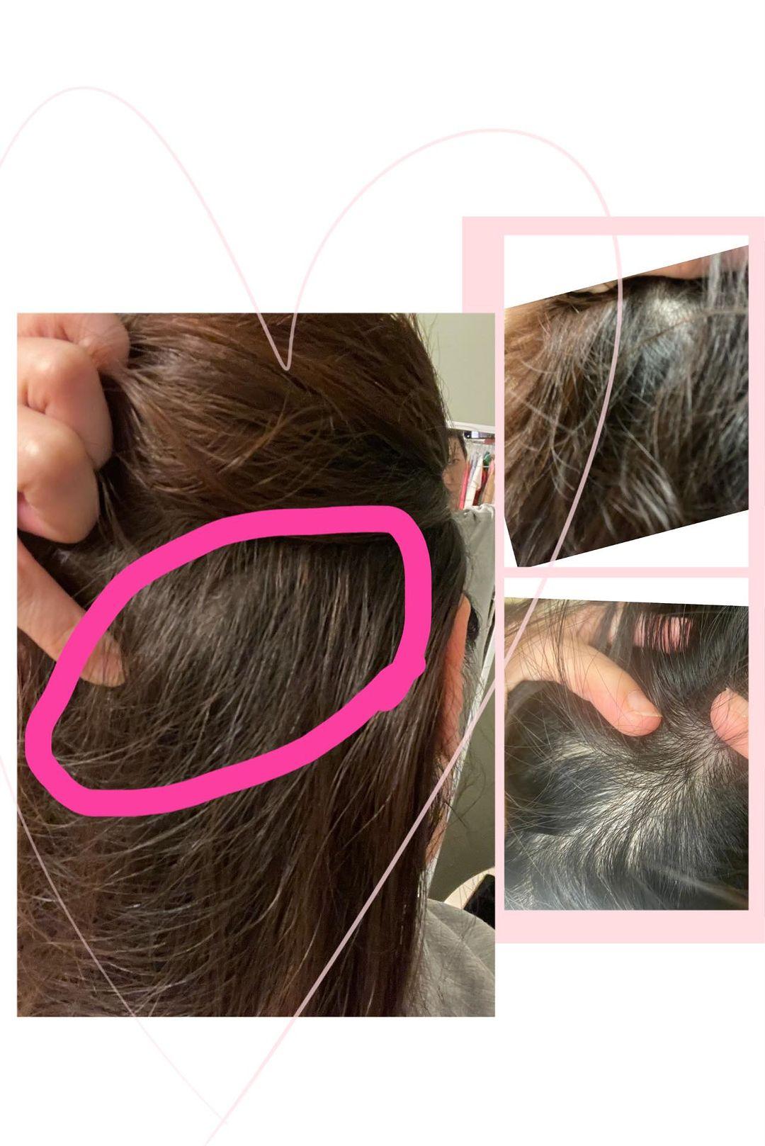 廖家儀後腦勺突然浮腫起一條筋。（圖／翻攝自廖家儀IG）