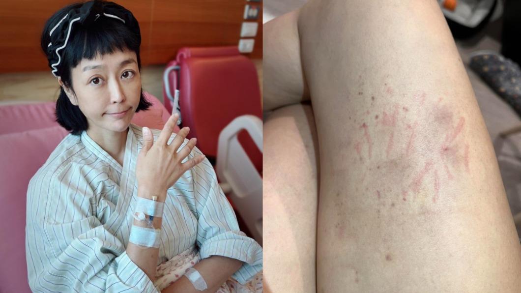 癌末割卵巢子宮續命!唐玲「大腿滿血痕」 嚴重後遺症曝