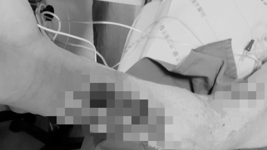 被魚刺到“整隻手壞死”! 釣魚男就醫才知壞死性筋膜炎