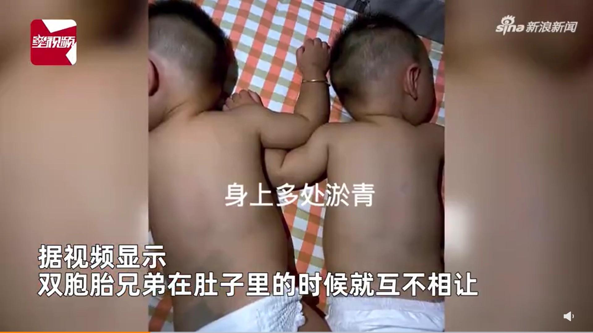 雙胞胎兄弟一出生就有許多瘀青。(圖/翻攝自微博)