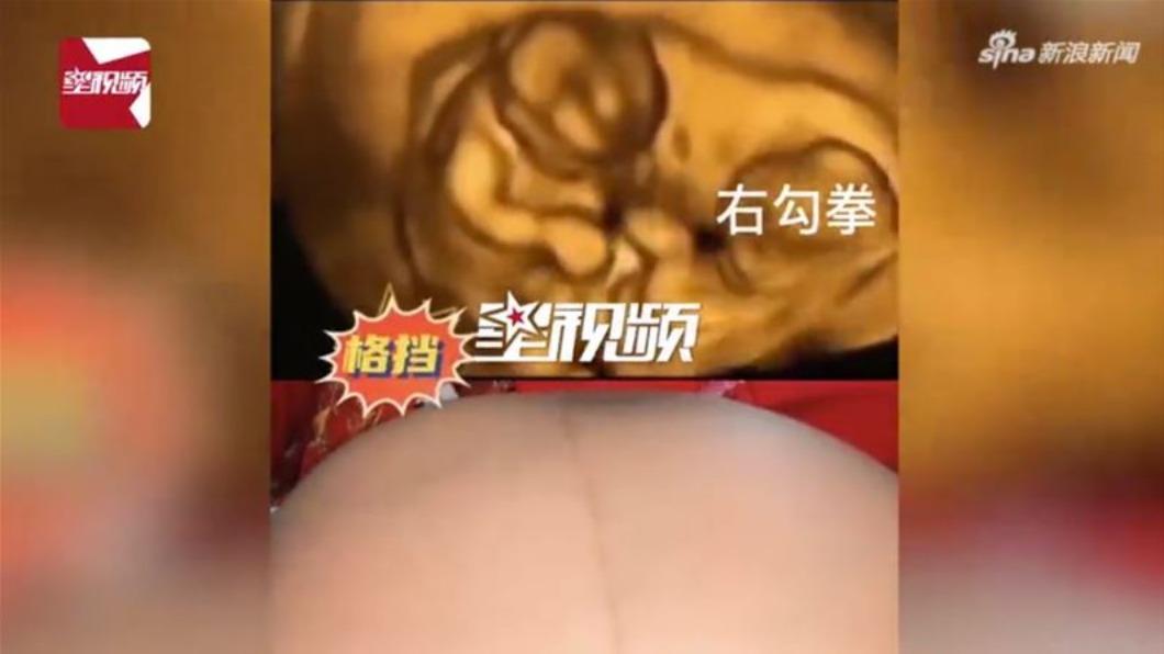 雙胞胎肚子裡打架!出生後「全身瘀青」媽笑哭:長大別怪我