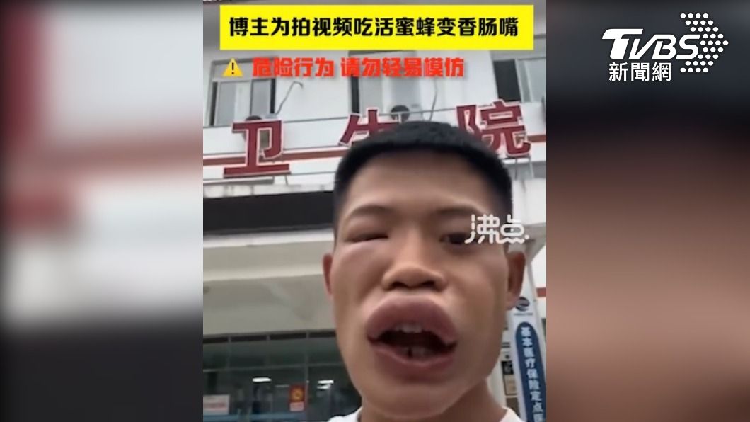 陸網紅拚流量 表演生吃蜜蜂 遭蜂螫成香腸嘴