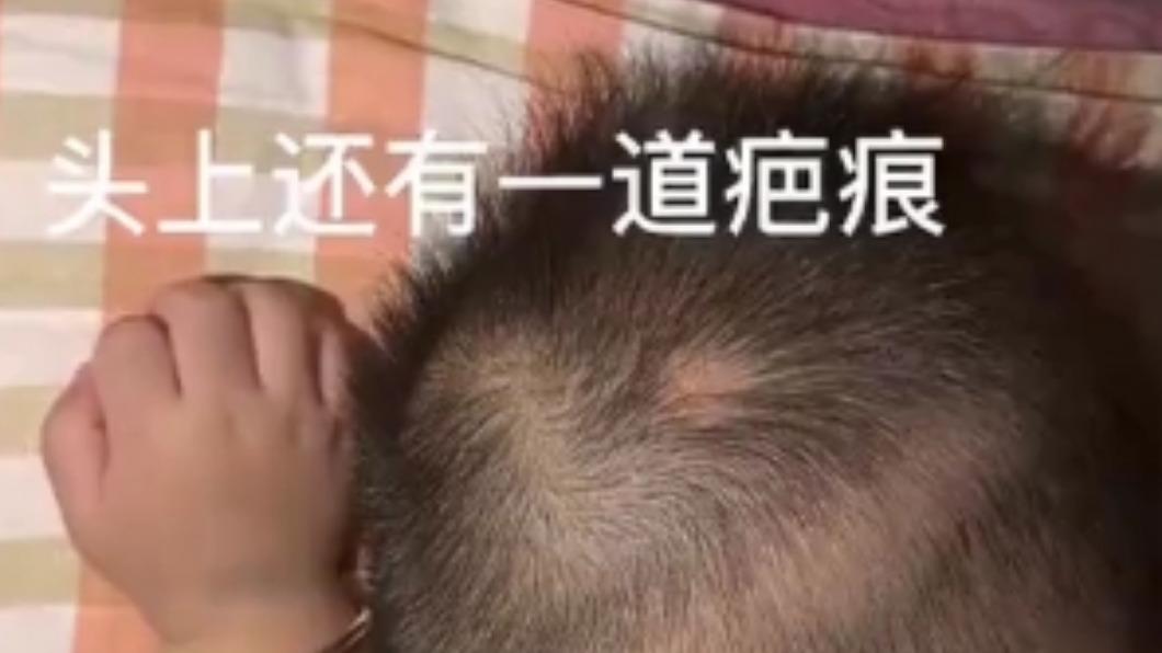 雙胞胎「疤痕」(圖/陸媒)