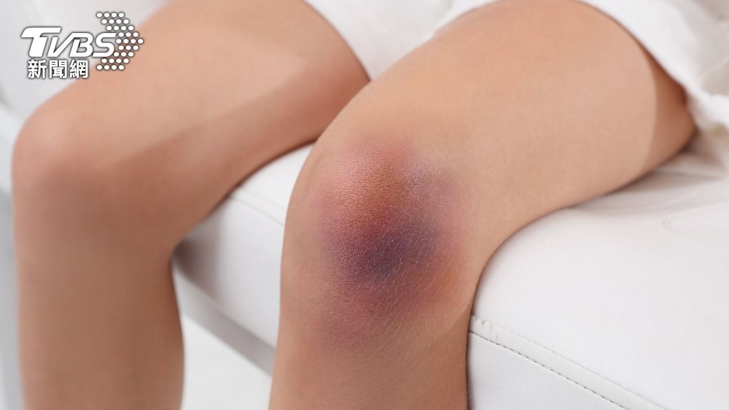 4旬女「狂冒不明瘀青」!檢查竟罹肝癌 見3症狀快就醫
