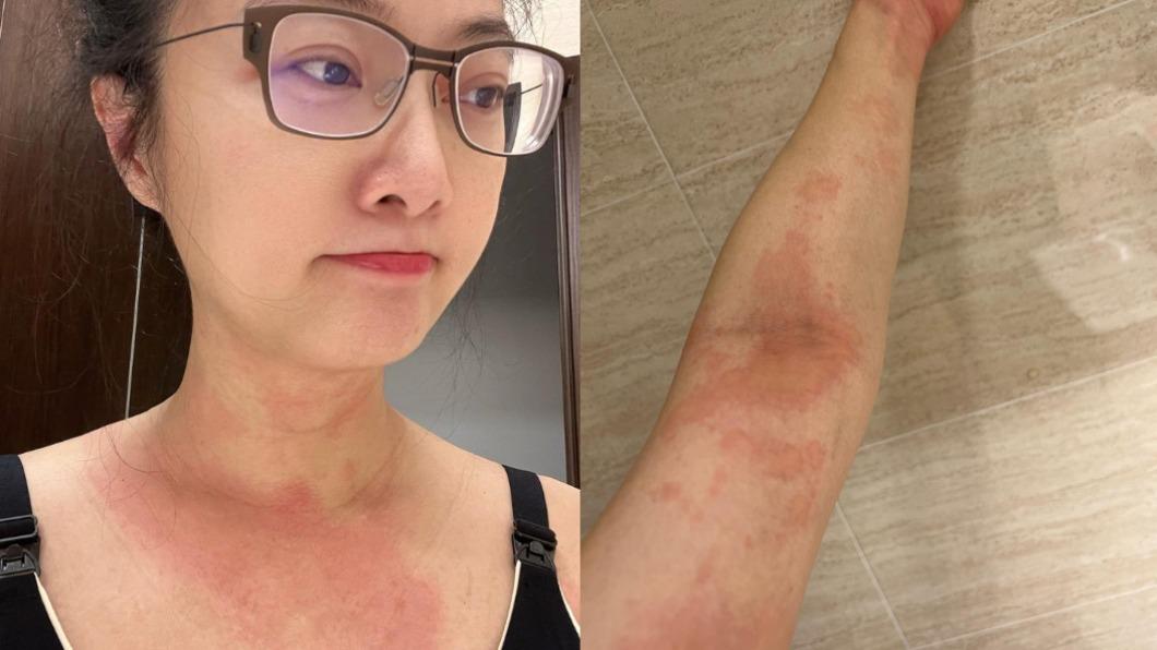 愛女才滿2個月!趙小僑「全身奇癢+發燙」苦嘆:又來了