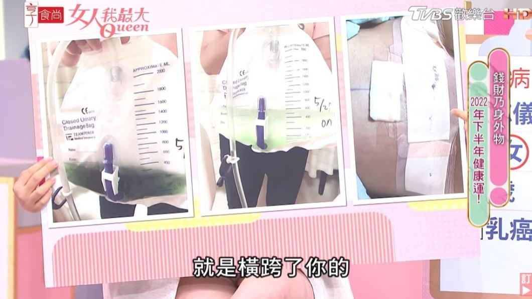朱芯儀曝光傷口照。（圖／翻攝自女人我最大YouTube）