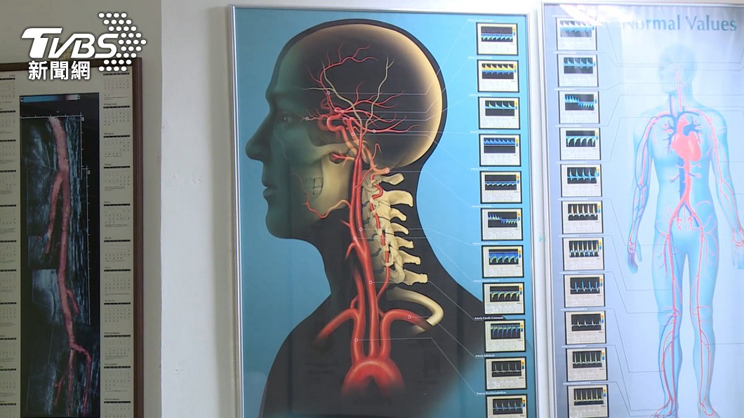 腦中風8大危險因子,包含:高血壓、糖尿病、膽固醇過高、心房顫動、運動量不足、肥胖、吸菸及腦中風家族史。(圖/TVBS)