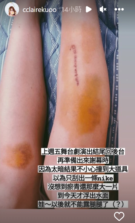郭靜在舞台上不小心受傷。（圖／翻攝自郭靜 IG） 