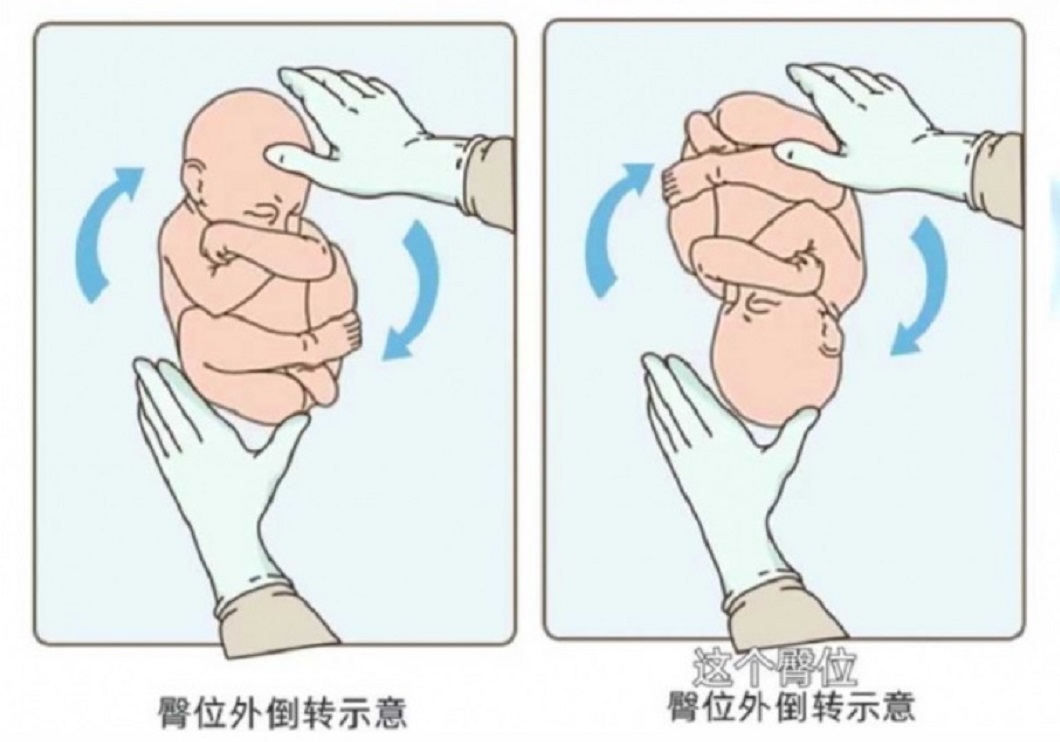 醫師呼籲若出現這種情況孕婦或家人千萬別自己喬一定要找醫師。（圖／翻攝自長春晚報）
