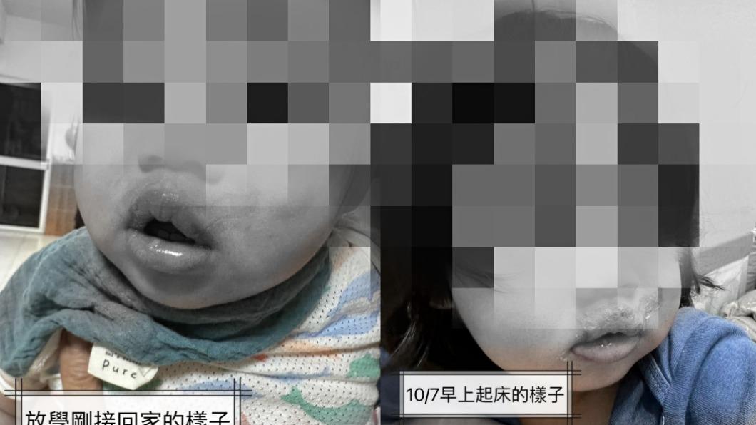70度水泡奶!高雄1歲女童成「臘腸嘴」 師扯:摸了不會燙