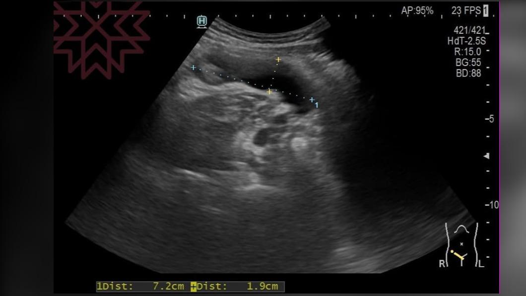 男大腸鏡照2次..沒見腫瘤！他一看「是大香腸」驚呆了