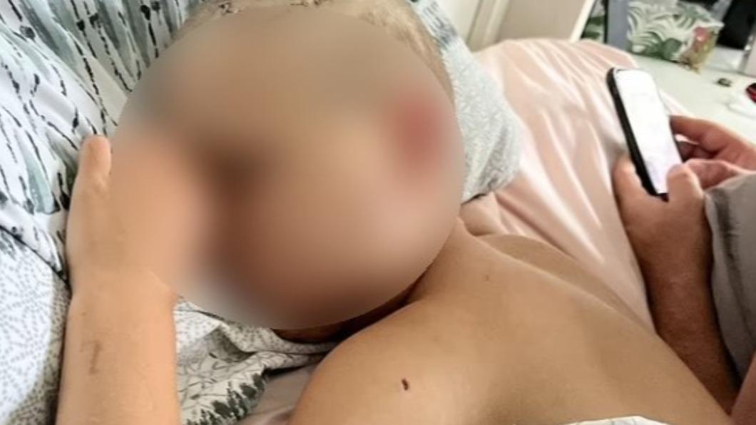男童的頭頂、臉皮、下巴均留下駭人的疤痕,未來恐須經歷長時間的心理重建。(圖/翻攝自《每日郵報》)