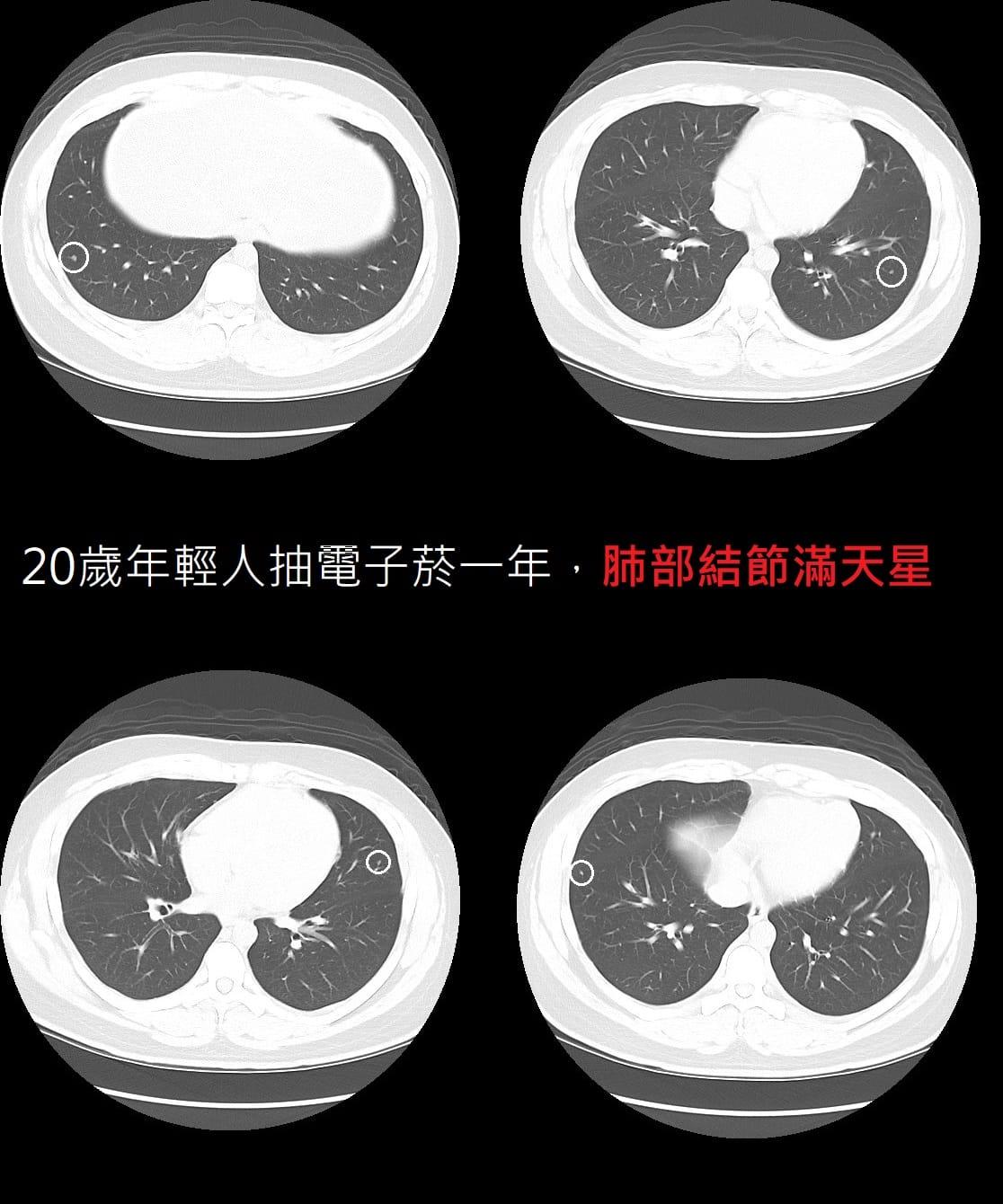 20歲男肺部出現結節滿天星。（圖／翻攝自蘇一峰臉書）