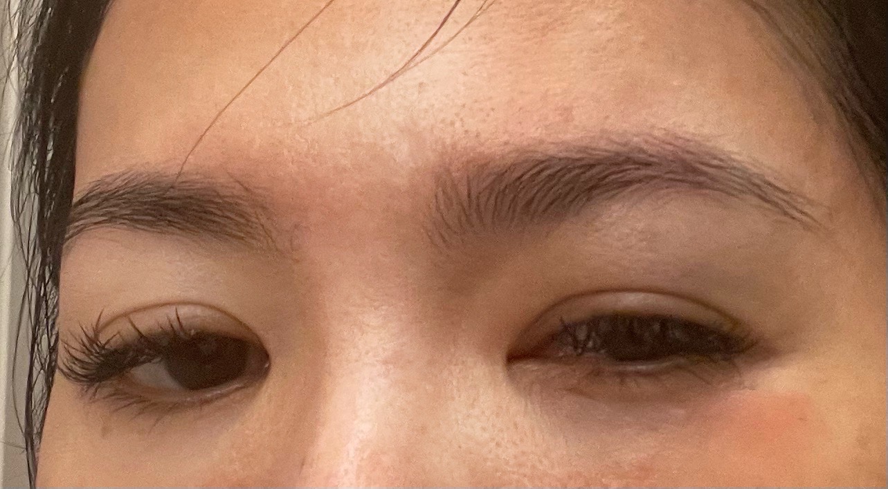 星卉剛撞傷時左眼張不開。(圖/星卉提供)