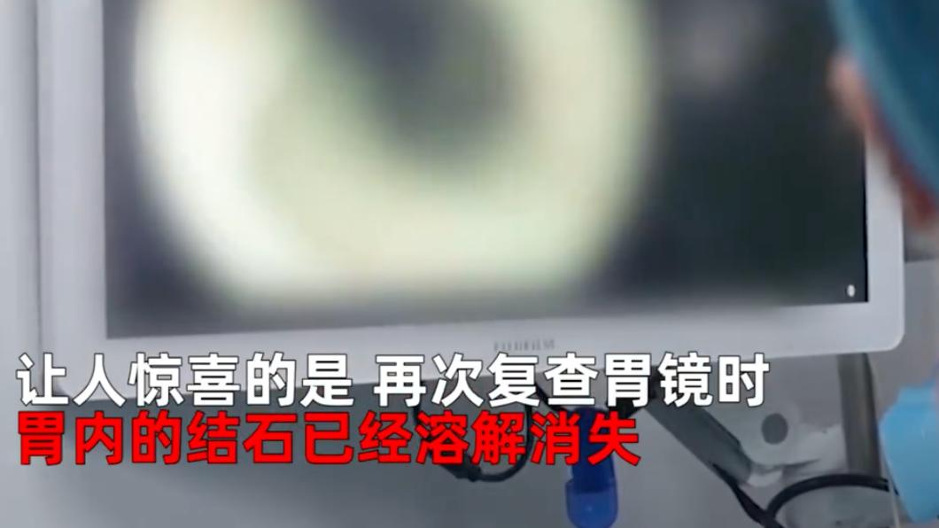 一週後可樂竟溶解了胃結石。（圖／翻攝自微博）