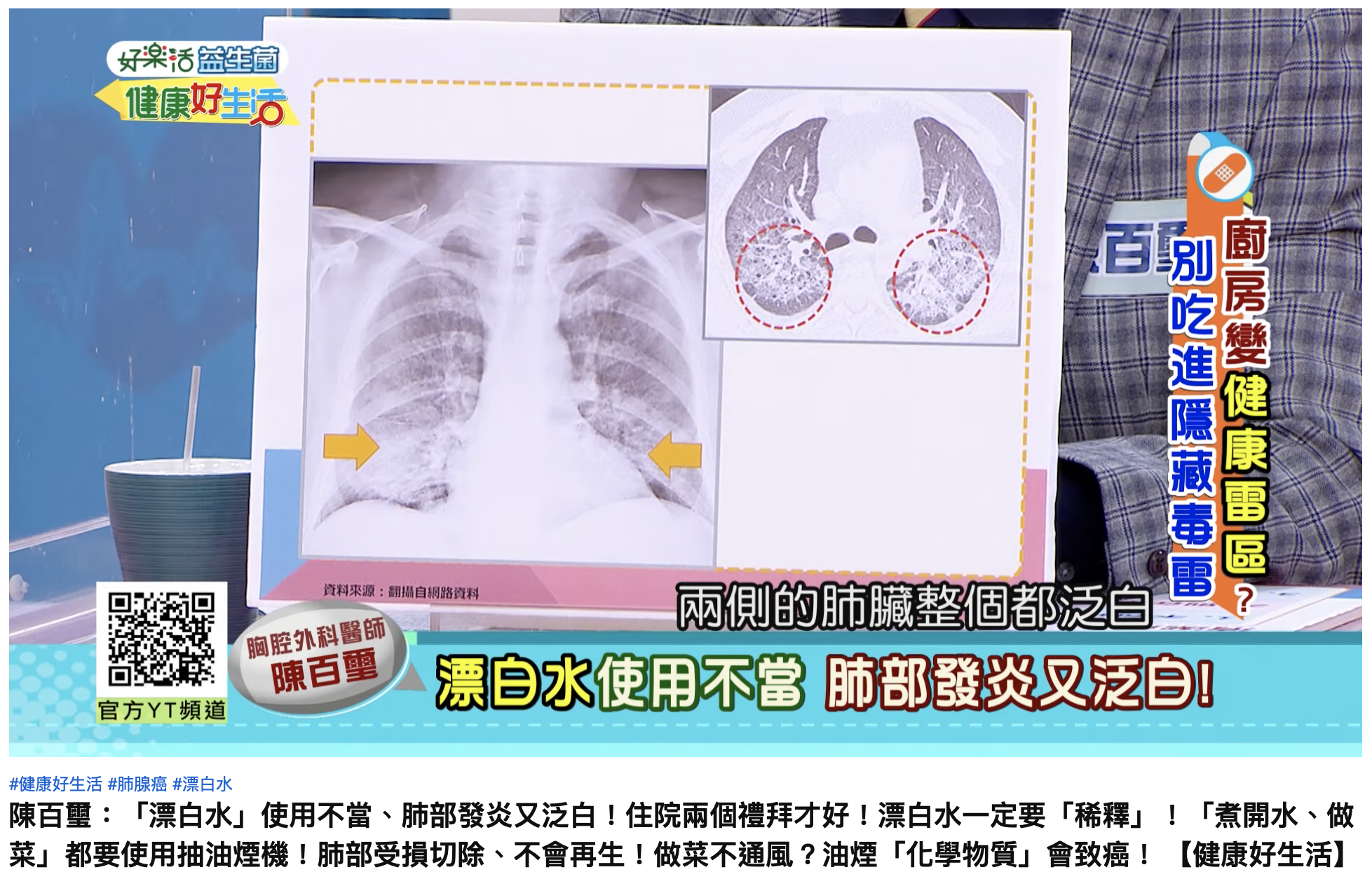 男子肺部兩側泛白,醫師指出是發炎。(圖/翻攝自YouTube「年代MUCH台 健康好生活」)