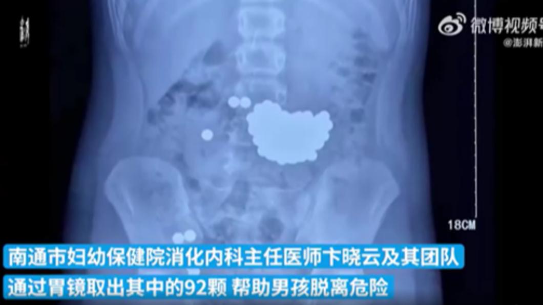 行為偏差!大陸10歲童跟父母吵架 狂吞百顆鋼珠腹痛急救