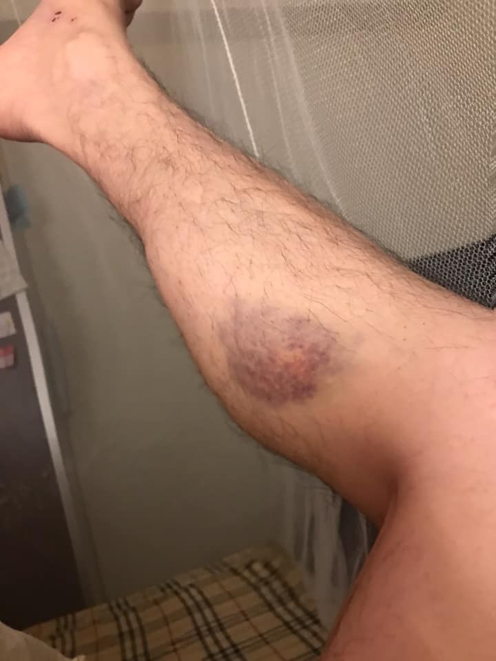 小炳去年膝蓋出現不明原因瘀青,證實罹患菌血症。(圖/翻攝自小炳 余俊賢臉書)