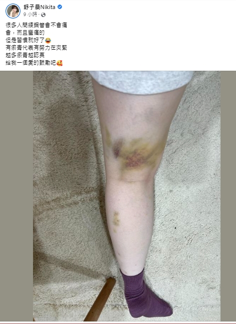 舒子晨大腿嫩肉瘀青嚴重。(圖/翻攝自舒子晨臉書)