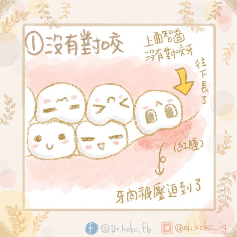 智齒往下長,就需要拔除。(圖/翻攝自柯佩伶臉書)