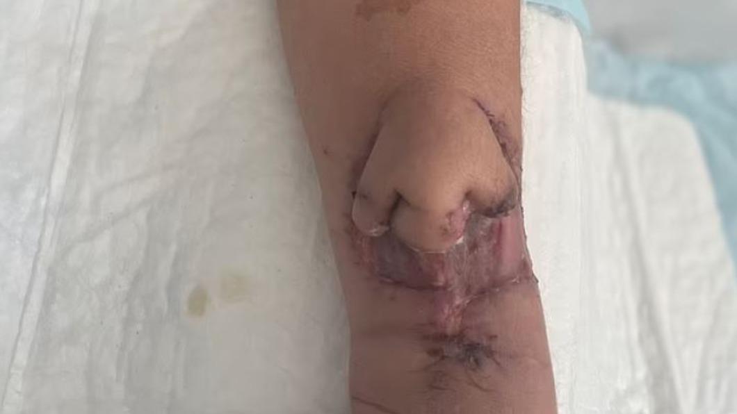 手臂離奇「長出肉鼻」！罹癌女成功移植　竟真的能呼吸