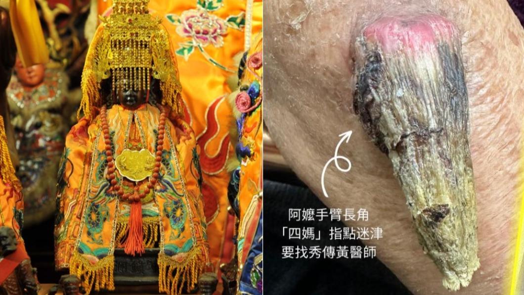 媽祖顯靈了!嬤長7公分惡魔角 開「仙界轉診單」救回一命