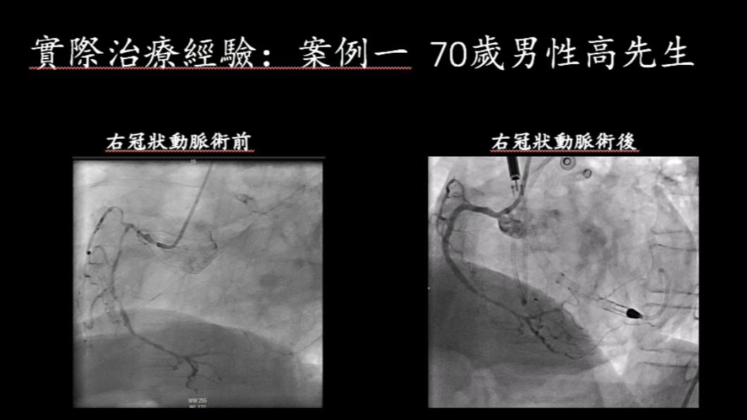 台大醫院使用新型暫時性機械式循環輔助系統,完成全台首2例複雜心導管手術。(圖/台大醫院提供)