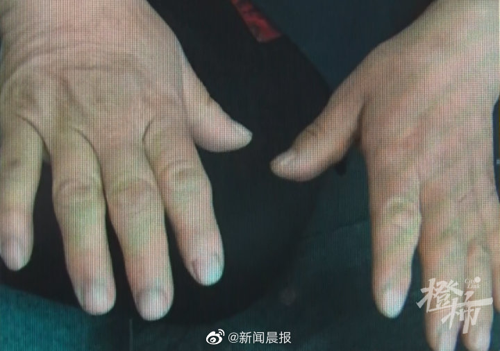 朱姓婦人手指粗大。（圖／翻攝新聞晨報微博）