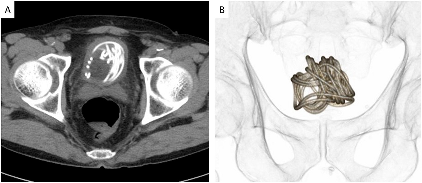 醫護人員當下看到也傻眼了。(圖/翻攝自泌尿外科病例報告(Urology Case Reports)官網)