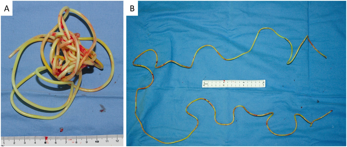 所幸最後透過手術順利取出。(圖/翻攝自泌尿外科病例報告(Urology Case Reports)官網)