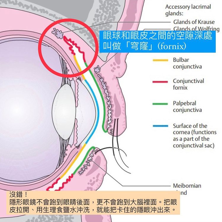 隱形眼鏡在眼中消失可能是跑到「穹窿」。(圖/翻攝自闕壯理醫師IG)