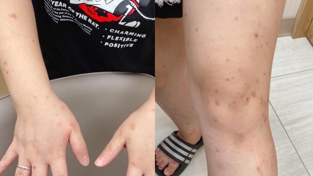 顏俊宇表示,疥瘡傳染力很強,常常一人感染全家遭殃。(圖/翻攝自顏俊宇醫師臉書)