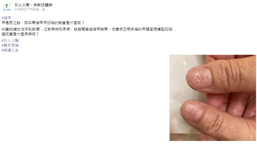 一名五旬婦人無特別疾病,雙手指甲的甲腹卻呈橫型凹陷。(圖/翻攝自引人入腎・林軒任醫師臉書)