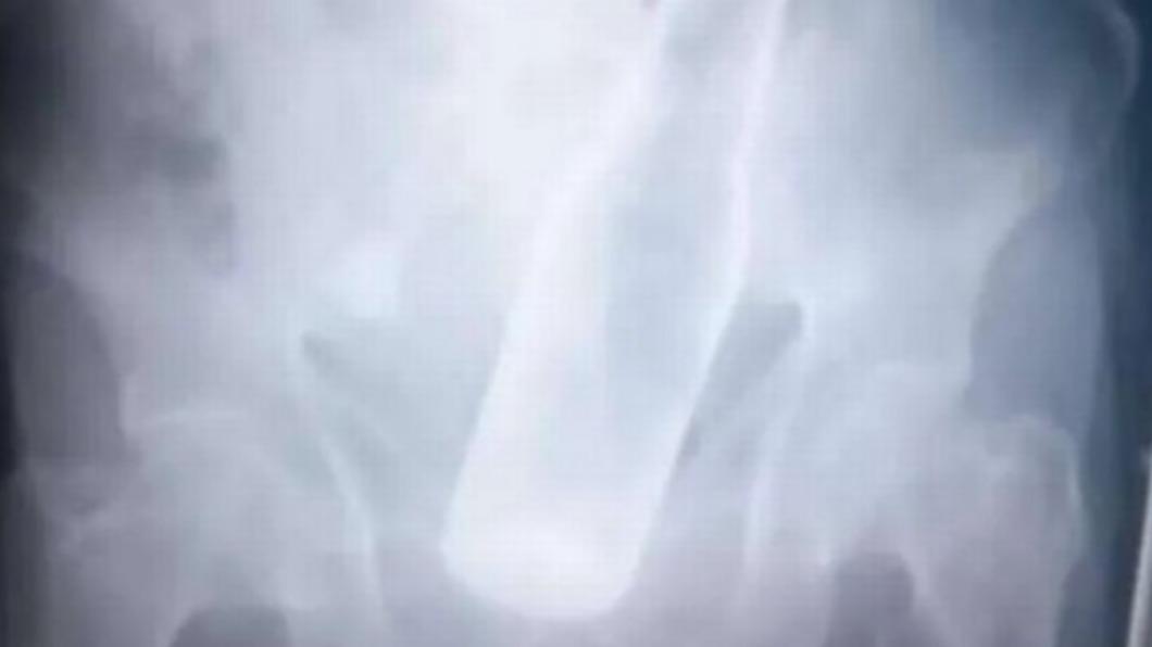 啤酒瓶「卡後門」!7旬翁痛苦就醫 崩潰:被強盜硬塞的