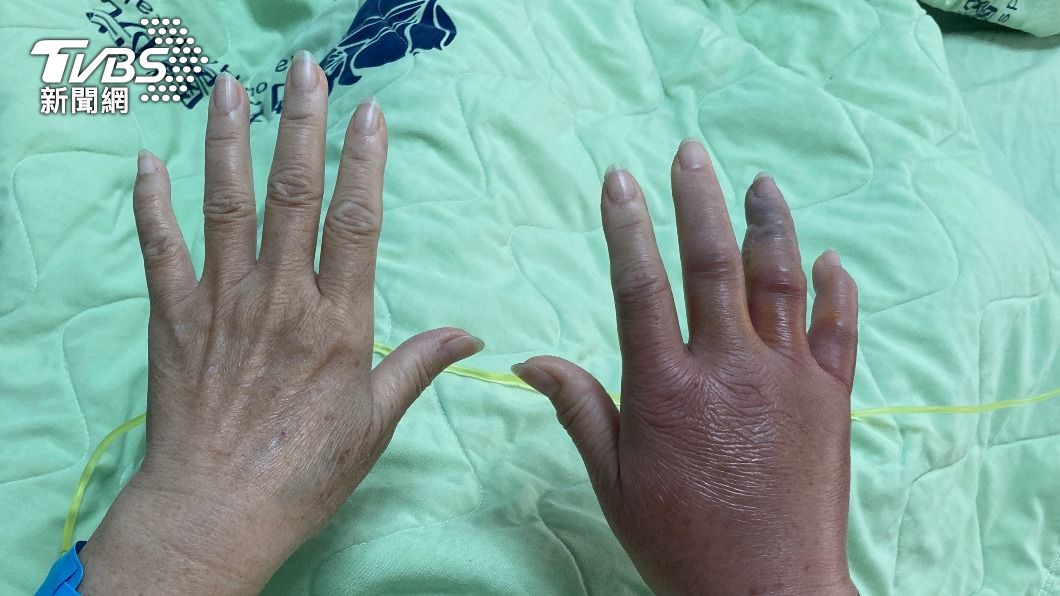 被海鮮感染海洋弧菌手紅腫發黑 南投8旬翁被迫截肢保命