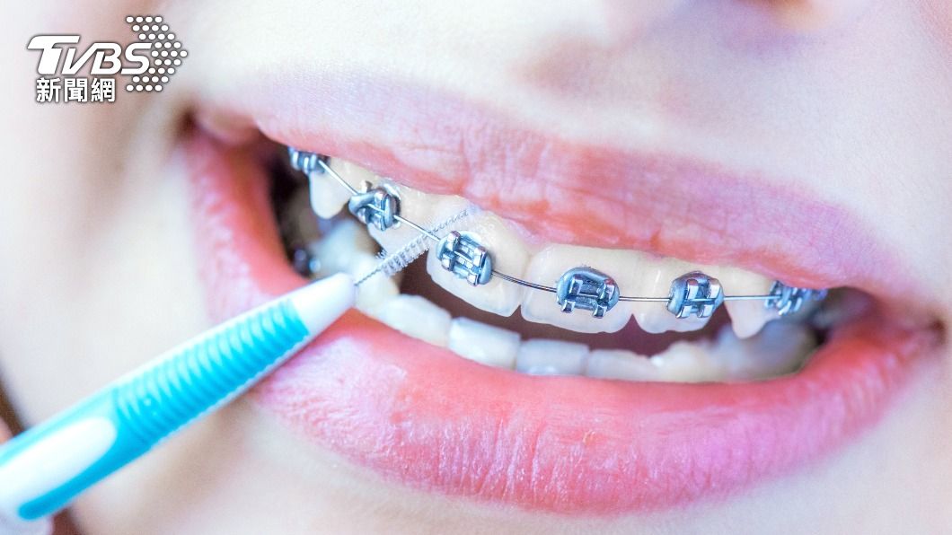 牙齒矯正的患者更需使用牙間刷。(示意圖/shutterstock達志影像)