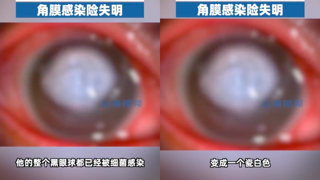 經檢查後男子黑眼球部分變成瓷白色。(圖/翻攝自微博)