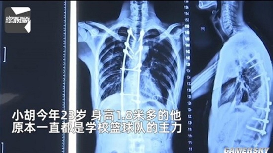 院方檢查後發現男子罹患了一種罕見疾病「脊柱大塊骨溶解症」。(圖/翻攝自新浪新聞)