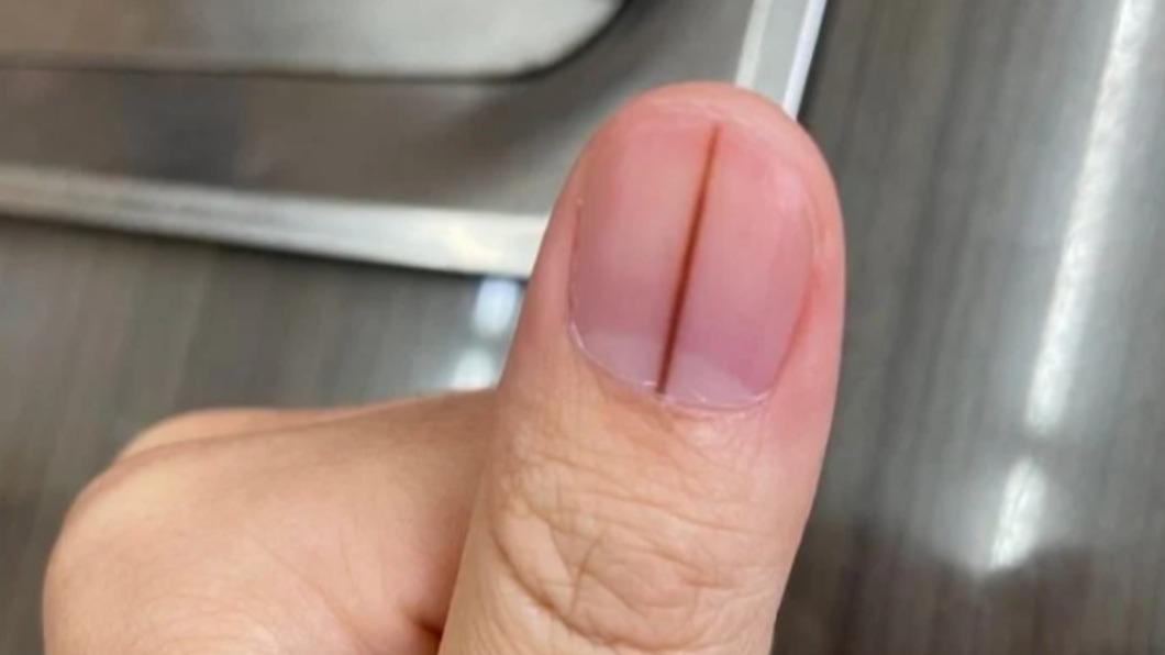 指甲突冒「詭異黑線」!過來人解答 醫曝1情況恐是癌王
