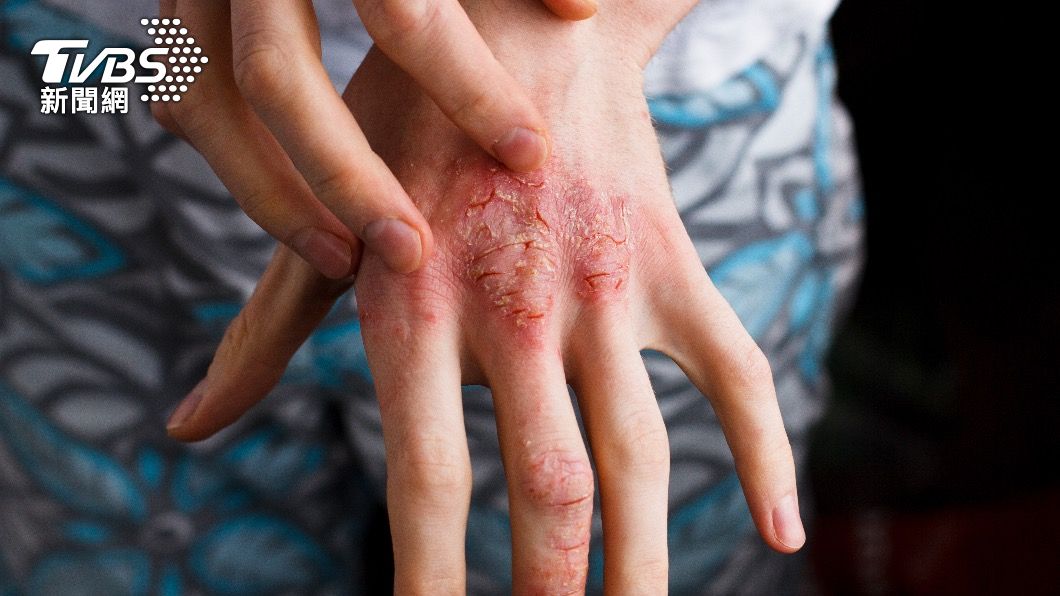 異位性皮膚炎會合併有不同症狀，如紅疹、脫皮、滲出組織液、結痂或苔癬化等。（示意圖／shutterstock達志影像）