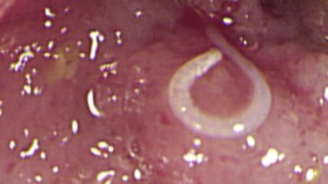 患者接受大腸鏡檢查後,意外發現大腸內有多隻白色鉤蟲亂鑽。(圖/翻攝自許秉毅臉書)